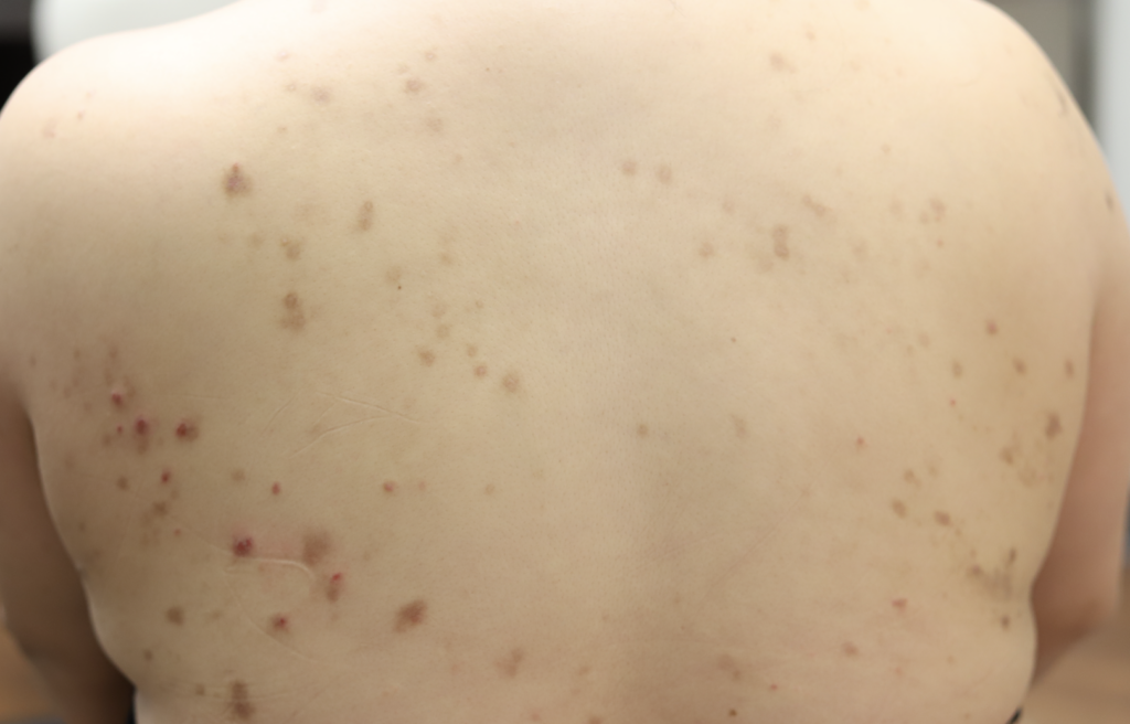 Psoriasis also affecting abdomen and back
